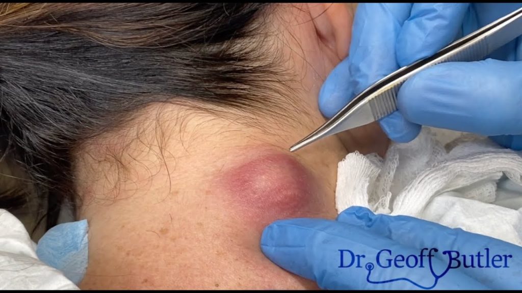 Drainage of an Inflamed epidermal cyst at the nape of the neck