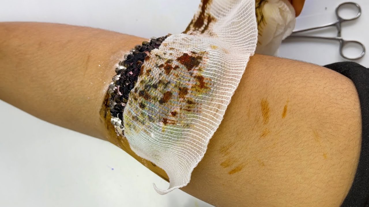 Cleaning ticks on human feet