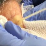 Large Cyst Squirts and Oozes from Patient’s Neck