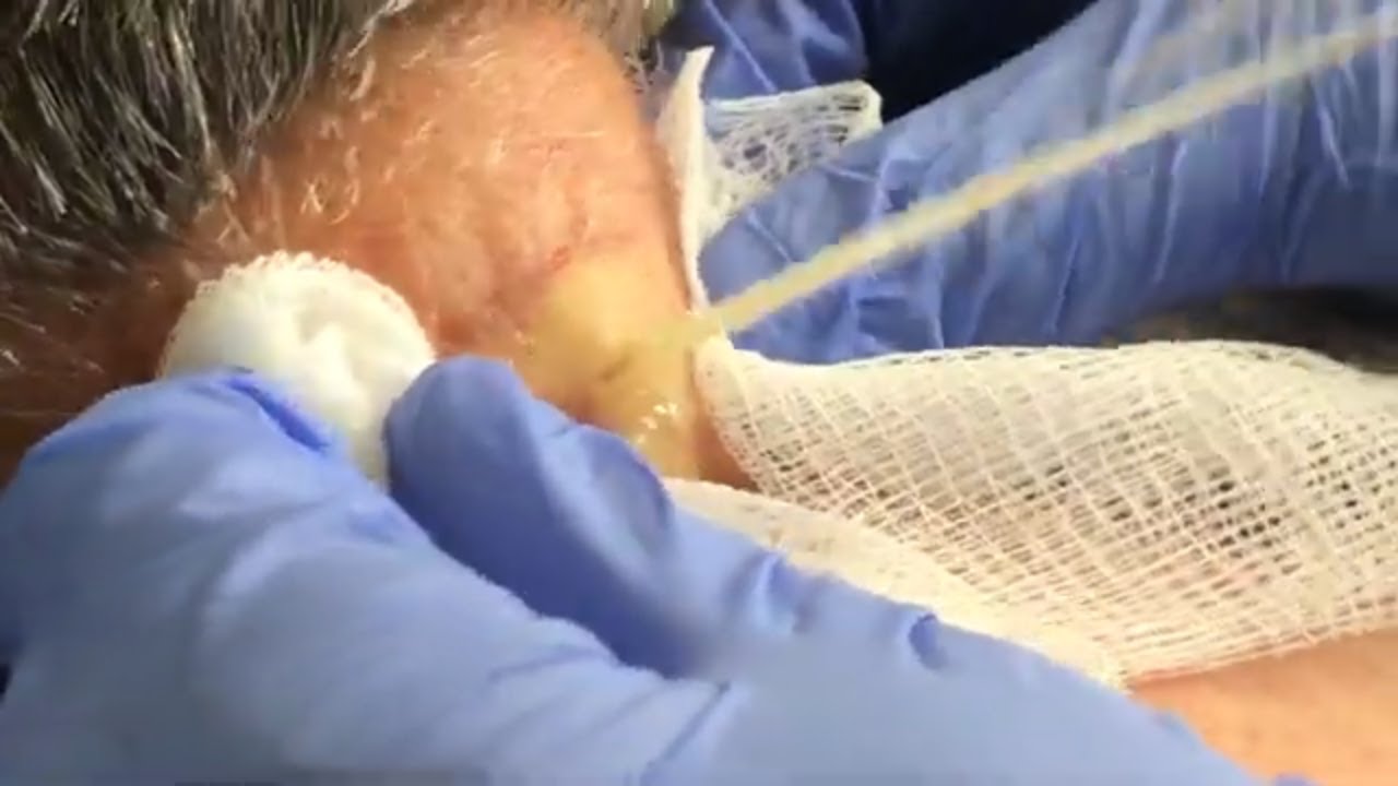 Large Cyst Squirts and Oozes from Patient’s Neck