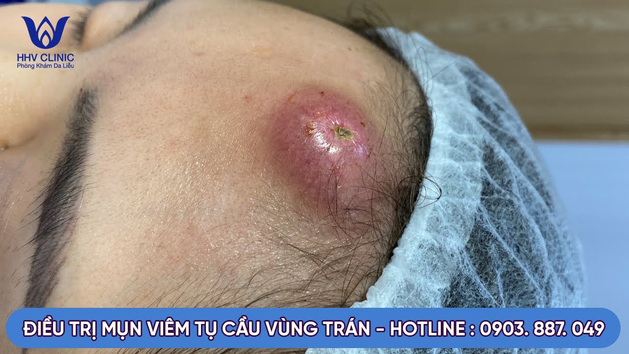TREATMENT OF STABICOCCAL ACNE IN THE FOREHEAD, COMMITMENT TO EFFECTIVE RESULTS AFTER 1 SESSION, NO DARK SPOTS, NO SCARS LEFT.