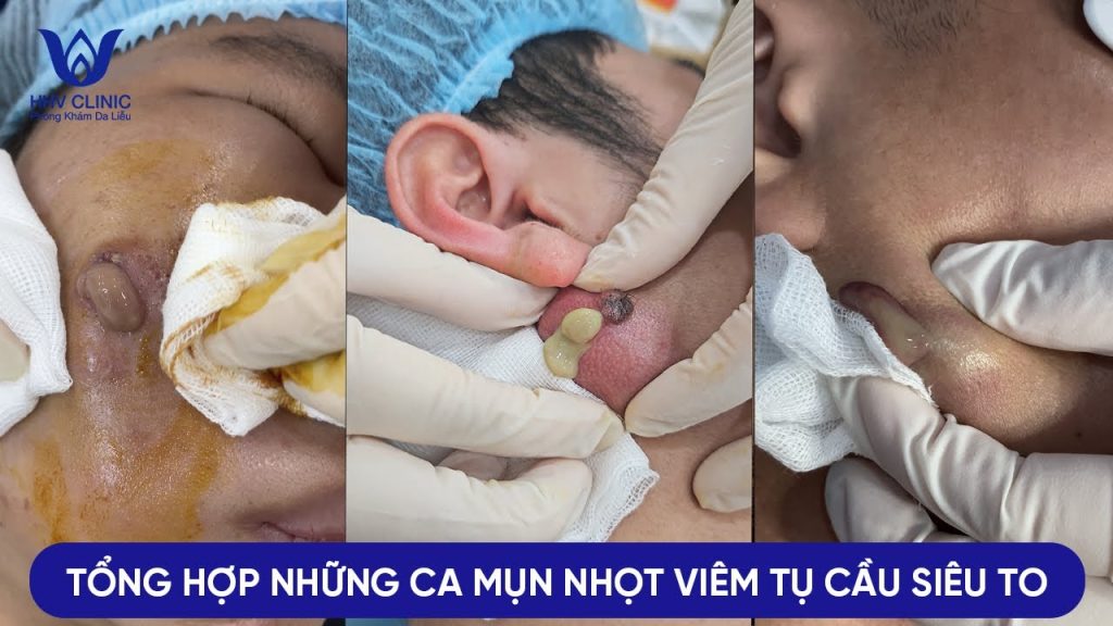 TREATING HUGE CASES OF STABLISHED ACNE