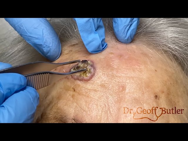 Modified Biopsy of Squamous Cell Cancer on Forehead
