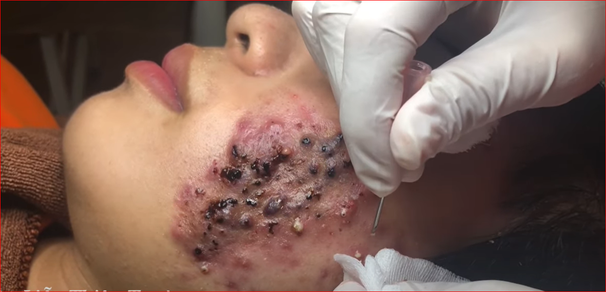 “Incision and Drainage of Buccal Space Infections: A Comprehensive Guide to Procedure, Indications, an