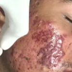 chemical peel for acne | acne treatment | Skinaa Clinic