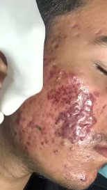 chemical peel for acne | acne treatment | Skinaa Clinic