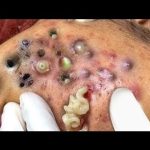 Blackhead removal | How to remove blackheads? | Blackheads whiteheads