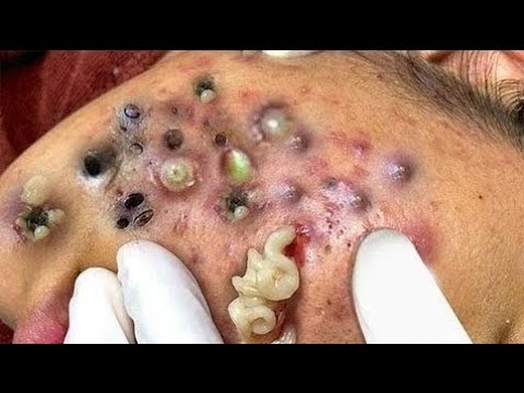 Blackhead removal | How to remove blackheads? | Blackheads whiteheads