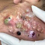 Blackhead removal