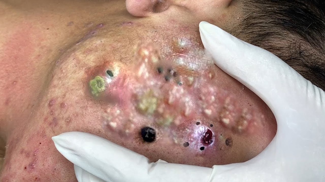 Blackhead removal