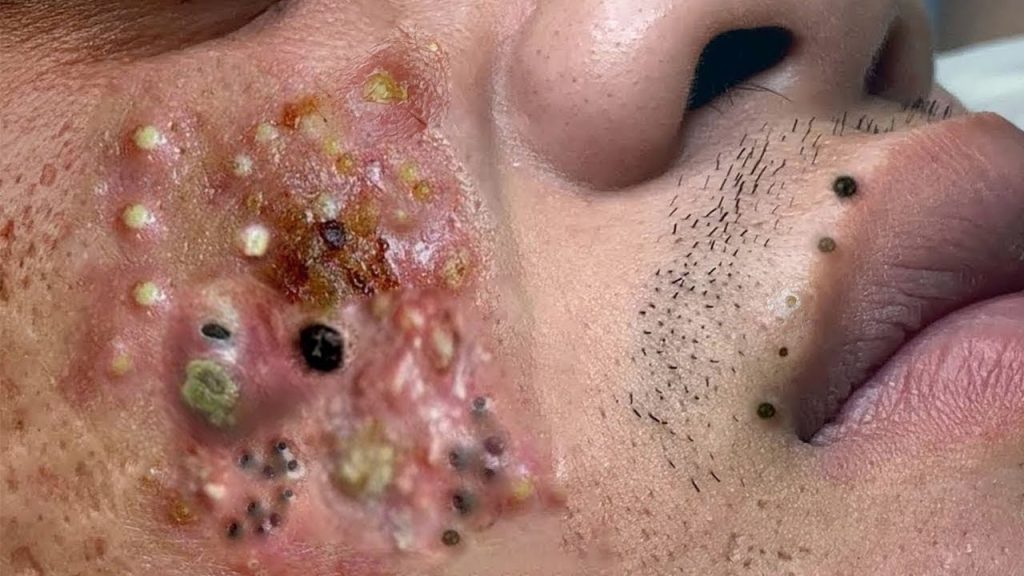 Black Peel Treatment For Acne  chemical peel for acne  acne treatment  Skinaa Clinic