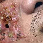 Black Peel Treatment For Acne  chemical peel for acne  acne treatment  Skinaa Clinic