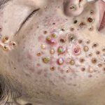 Acne extractions on severe inflammatory acne. Multiple blackheads and whiteheads.