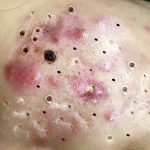 Get rid of acne scars