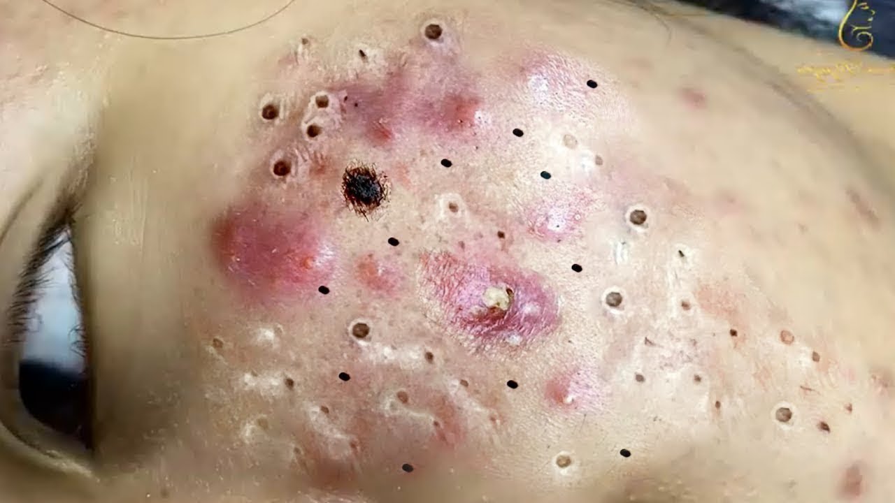 Get rid of acne scars