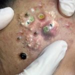 Satisfying Whiteheads extraction and Blackheads pimple popping