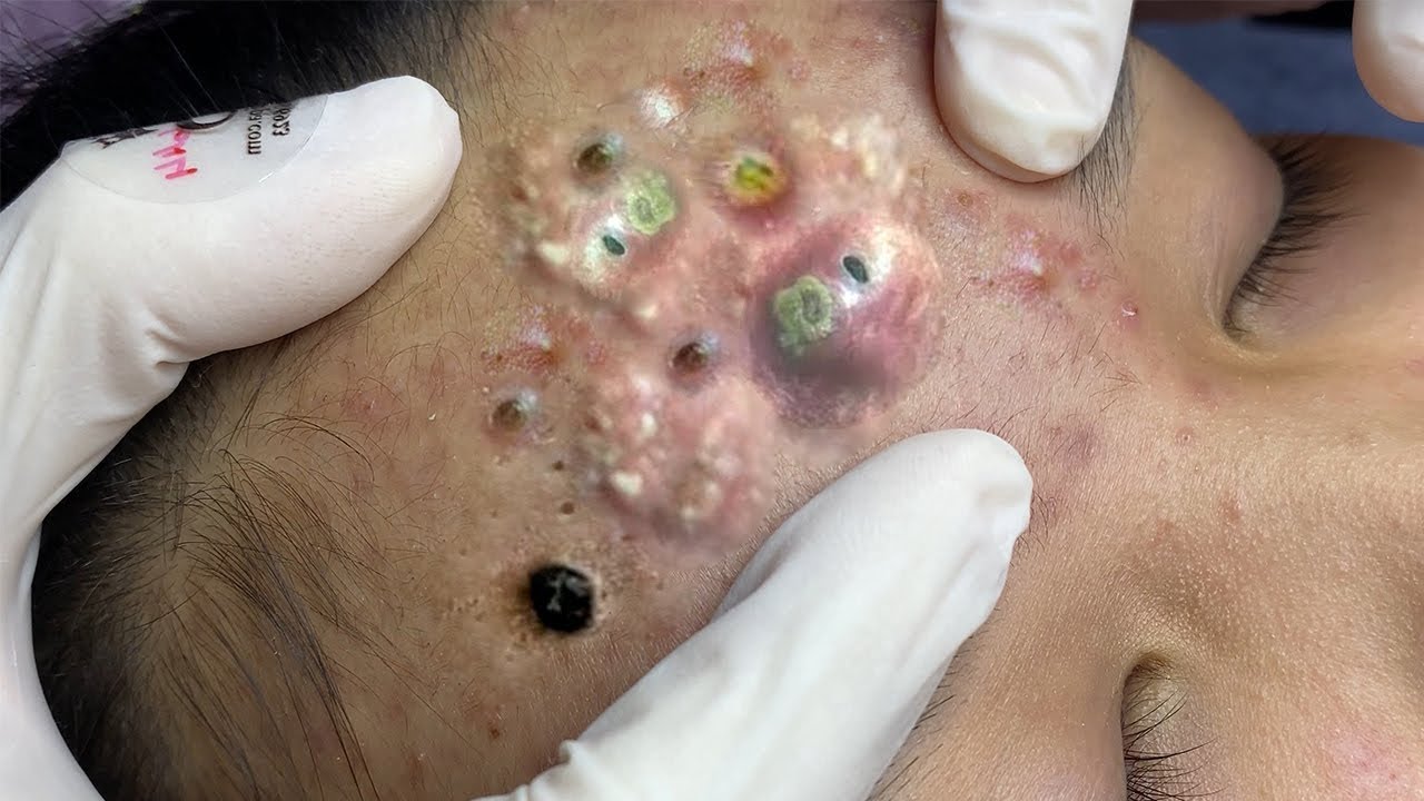Satisfying Whiteheads extraction and Blackheads pimple popping