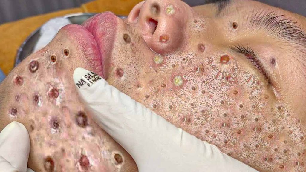 Massive BLACKHEAD REMOVAL – Most Blackheads 2025