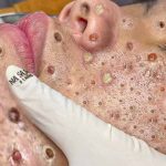 Massive BLACKHEAD REMOVAL – Most Blackheads 2025