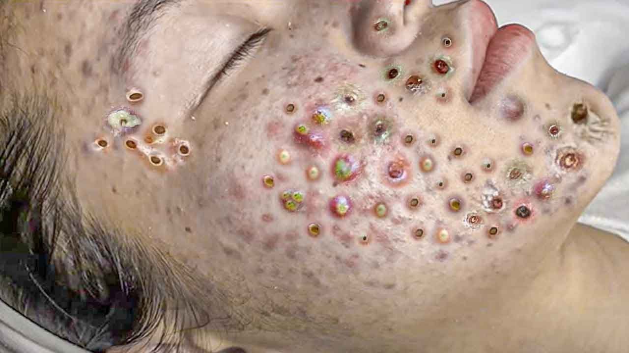 Acne extractions on severe inflammatory acne. Multiple blackheads and whiteheads.