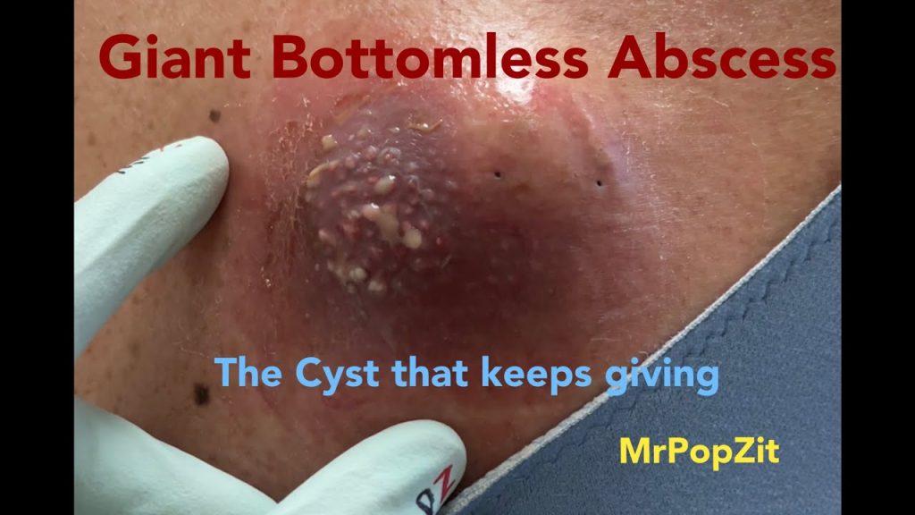 Huge cyst pop that just keeps going