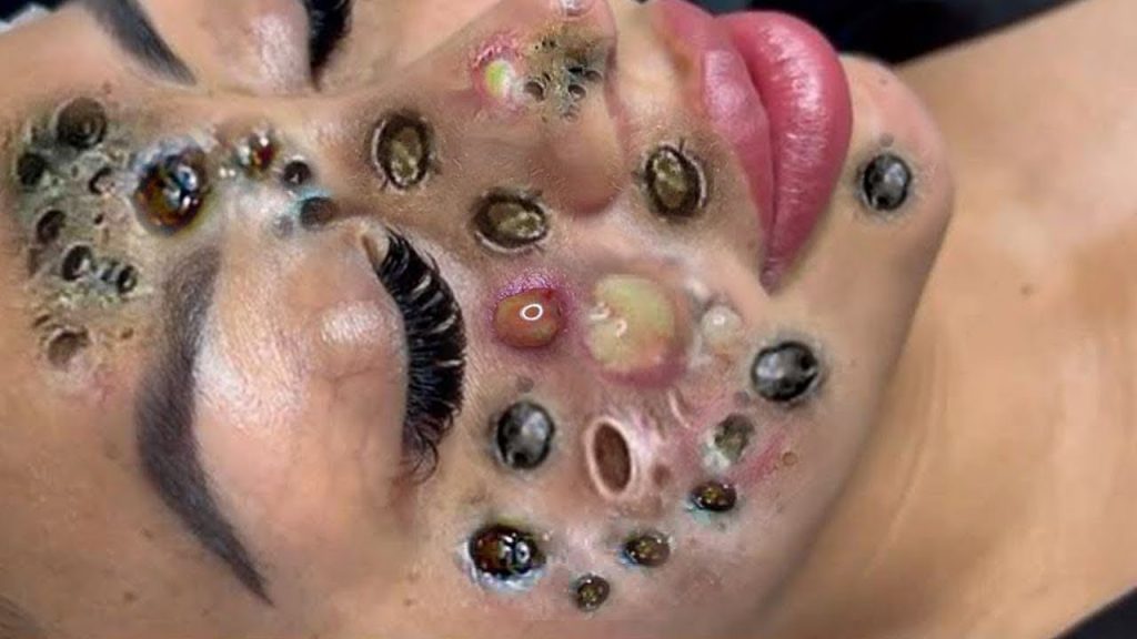 Get rid of acne, blackheads