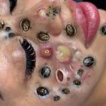 Get rid of acne, blackheads