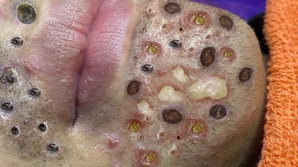 Satisfying pimple popping, Blackheads and Whiteheads