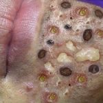 Satisfying pimple popping, Blackheads and Whiteheads
