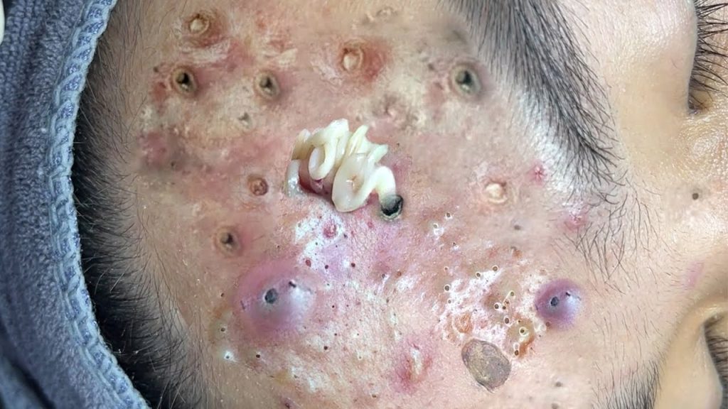 Look out for these pore of  extractions! 🩺