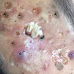 Look out for these pore of  extractions! 🩺