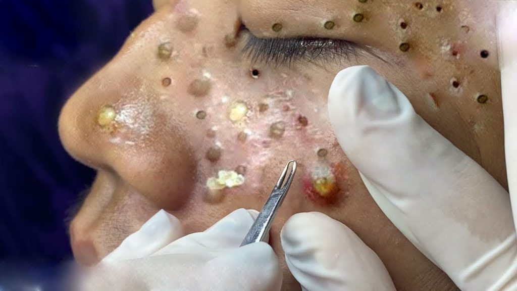 Enlarged pores before blackheads