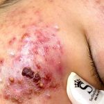 This is one of 5 types of acne scars