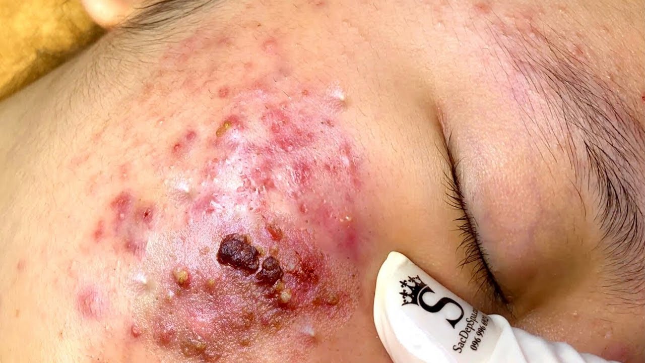 This is one of 5 types of acne scars