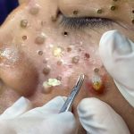 Enlarged pores before blackheads