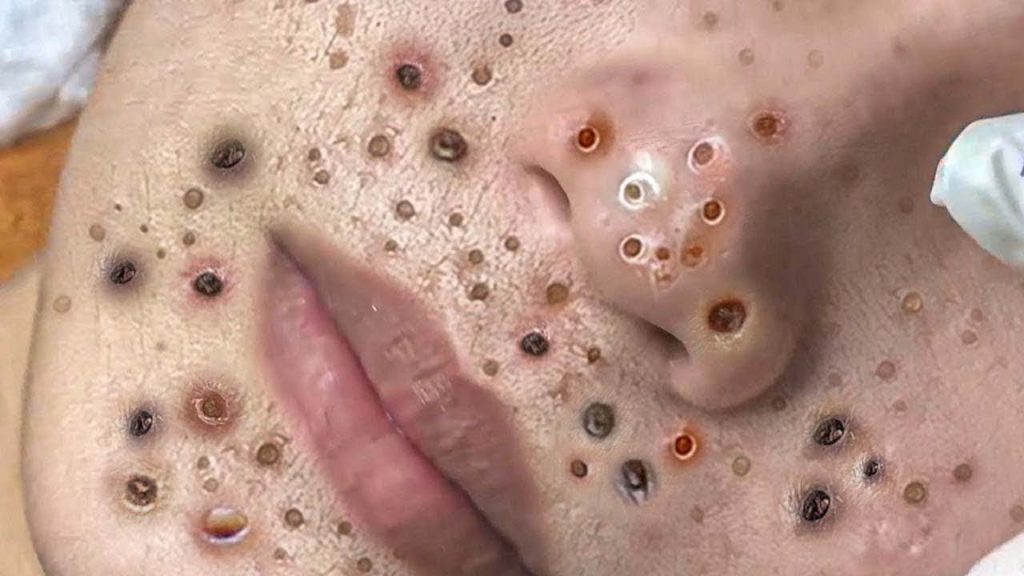 Satisfying Blackheads Removing from face, Acne and Whiteheads