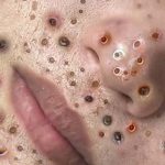 Satisfying Blackheads Removing from face, Acne and Whiteheads