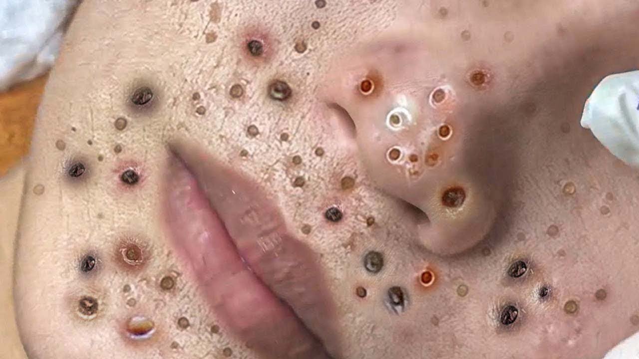 Satisfying Blackheads Removing from face, Acne and Whiteheads