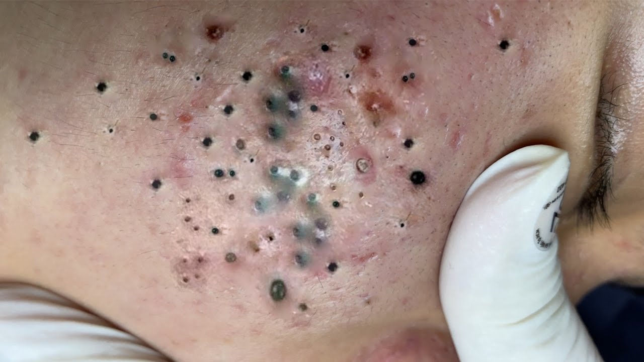 removal large blackheads popping