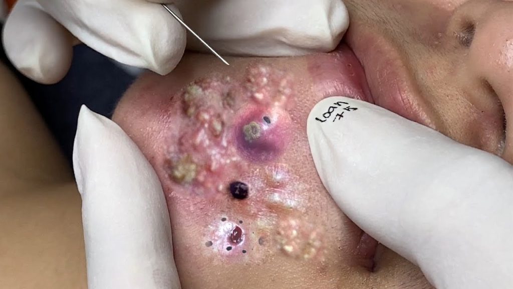 Get rid of blackheads
