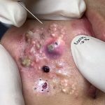 Get rid of blackheads