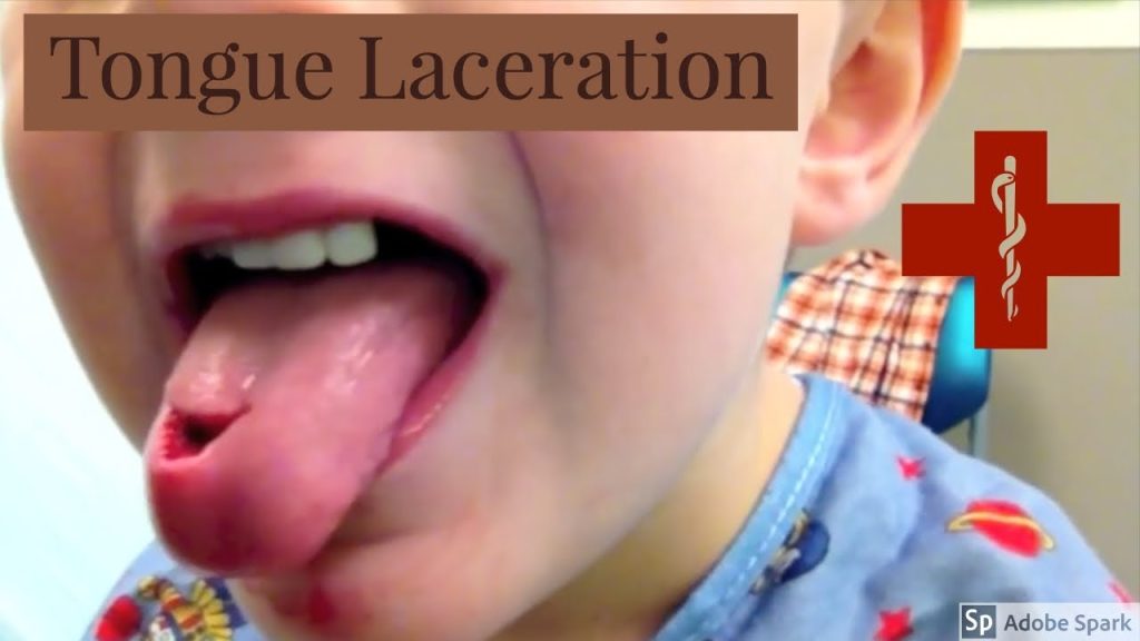 Deep Tongue Laceration – fix it or not?