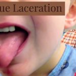 Deep Tongue Laceration – fix it or not?