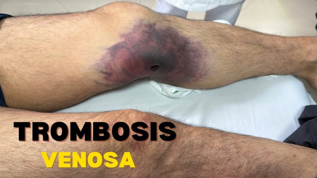 Venous Thrombosis