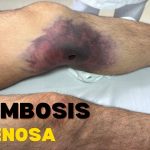 Venous Thrombosis