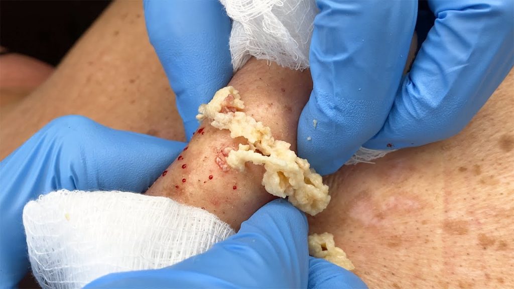 Large Cyst Squirts and Oozes from Patient’s Neck