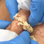 Large Cyst Squirts and Oozes from Patient’s Neck