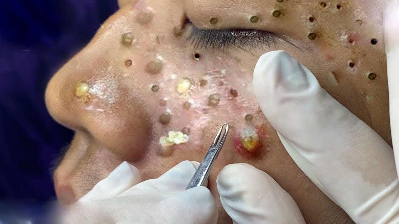 Enlarged pores before blackheads