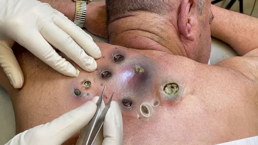 “Popped and Drained: How Dermatologists Handle Giant Cysts”