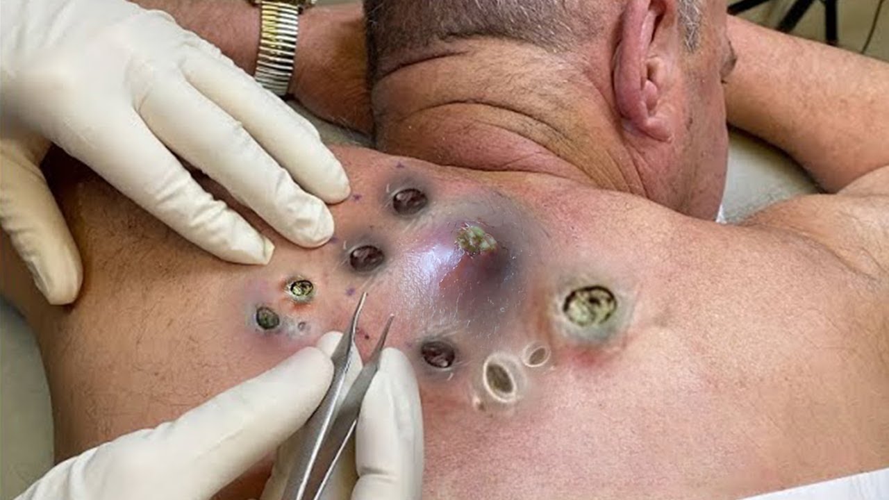 “Popped and Drained: How Dermatologists Handle Giant Cysts”